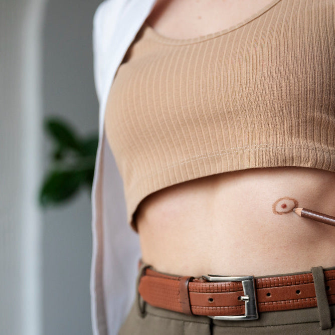 การดูแลตัวเองที่บ้านสำหรับผู้ป่วยที่ใช้ทวารเทียมหรือ Ostomy เป็นครั้งแรก